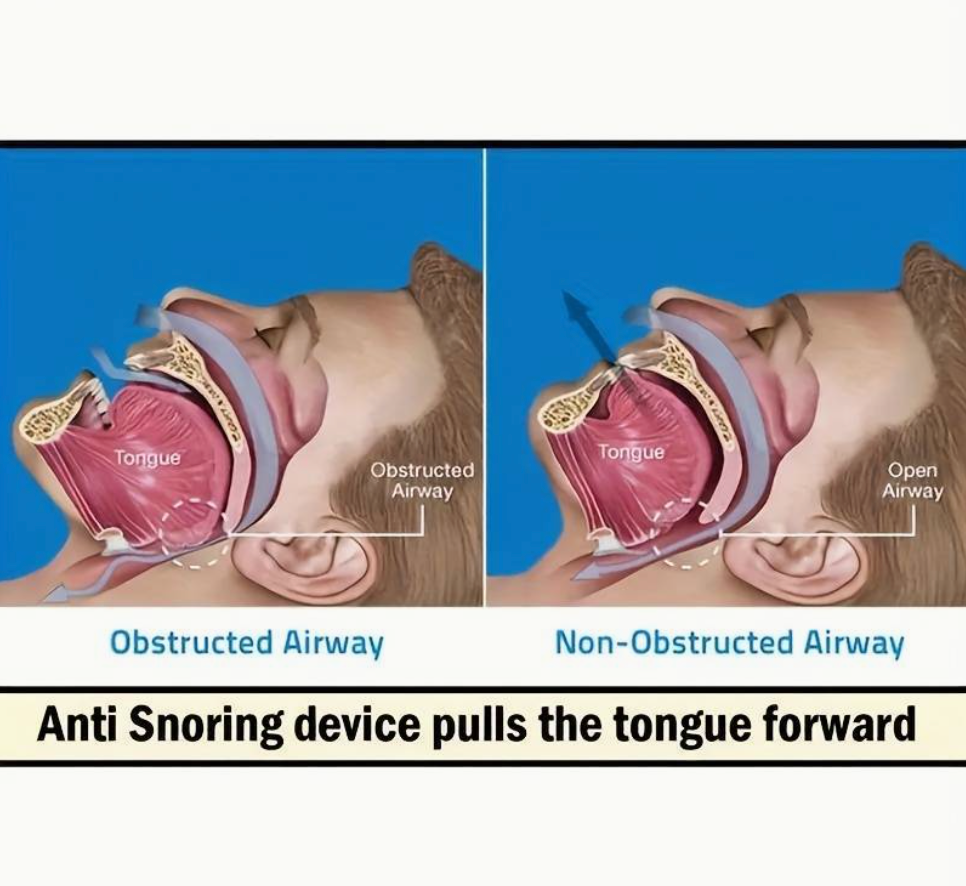 SleepEase MouthGuard - Nilola