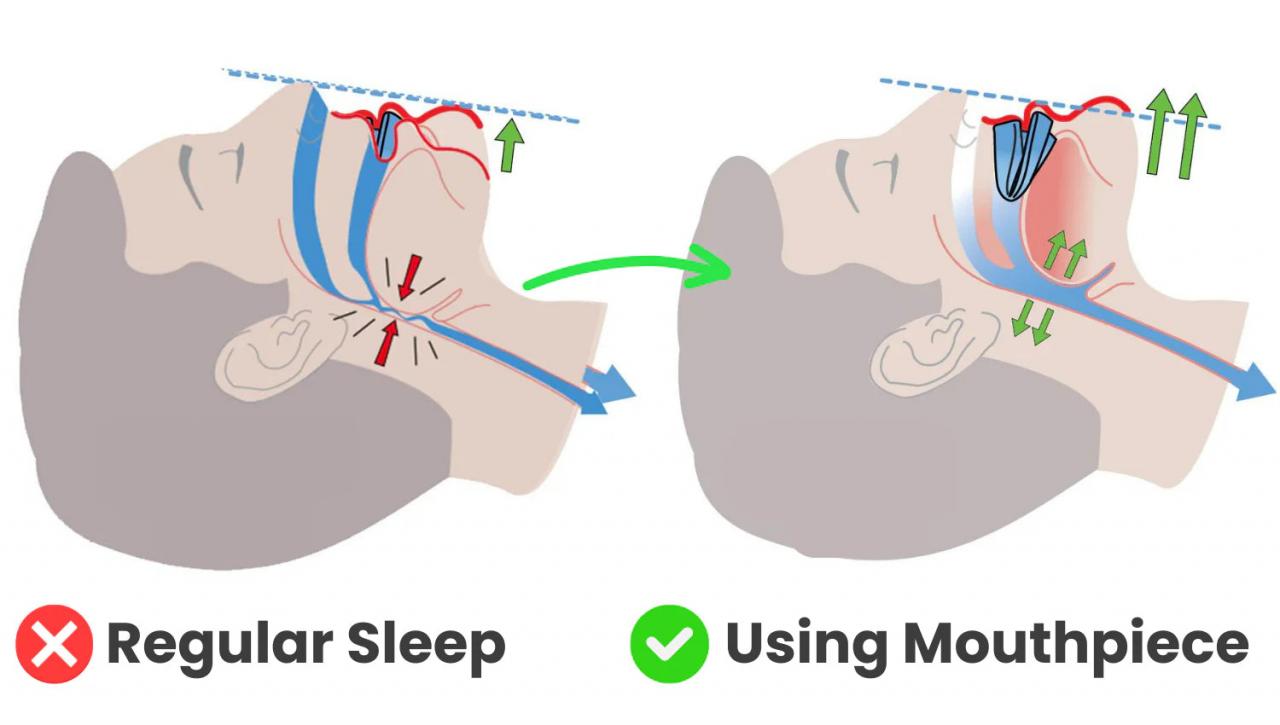 Anti Snoring Mouthpiece