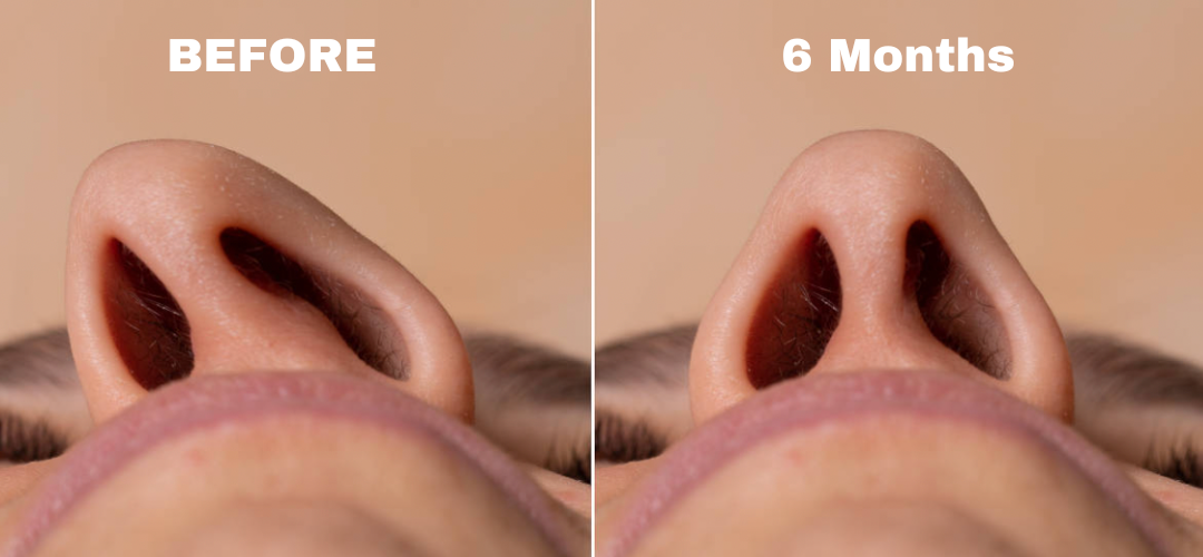 ClearNose - Magnetic Nose Strips